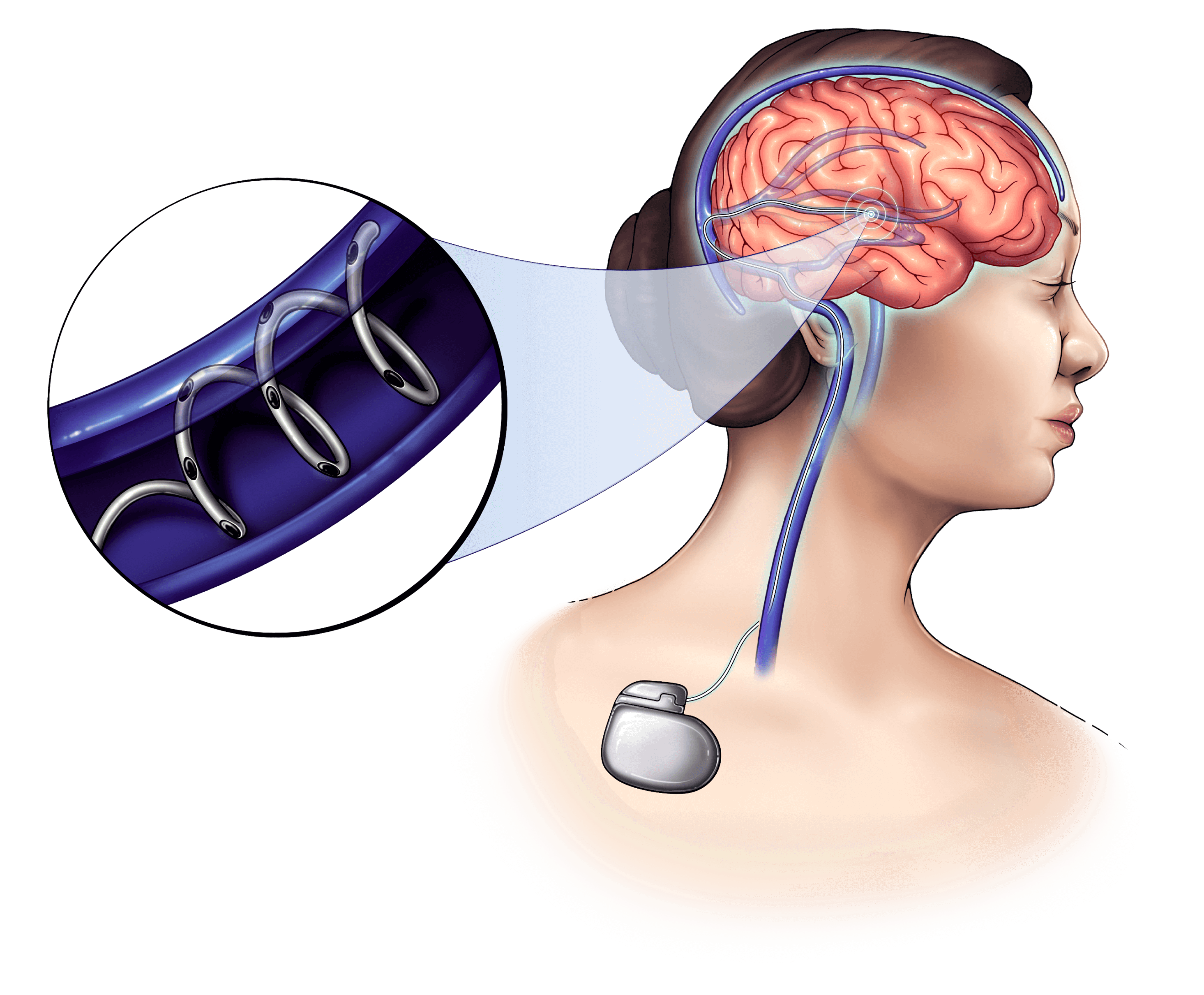 A diagram showing evstim being leveraged for neuromodulation and dbs.